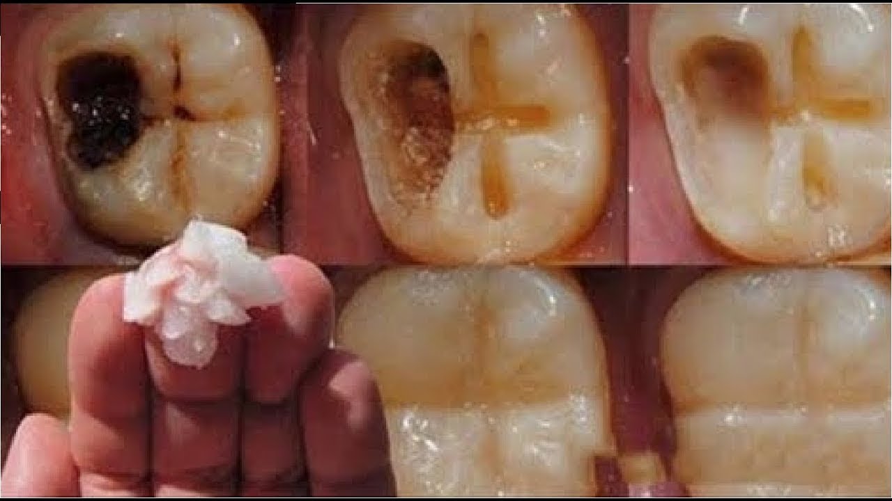 Diş çürümesinin ciddi zararları nedir