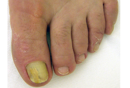 Yellow Nail Syndrome. About YNS syndrome; Causes ...