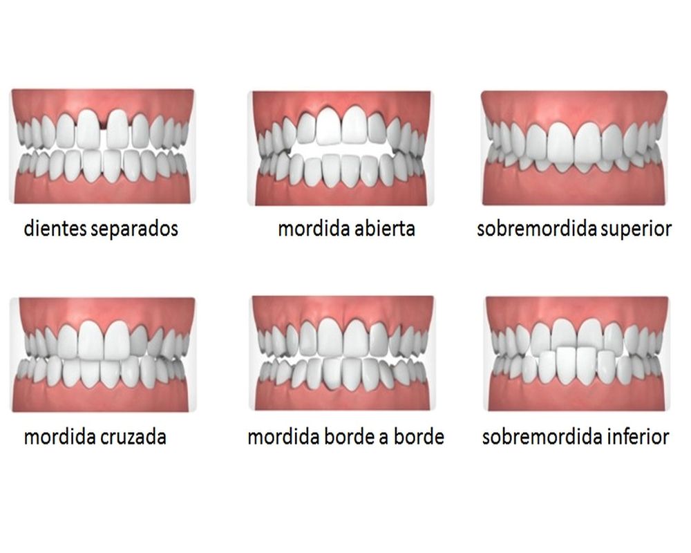 ¿Cuáles son las causas de una maloclusión? - OdontoVida