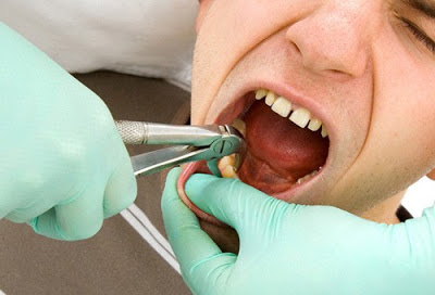 Răng cấm bị sâu có nên nhổ? 