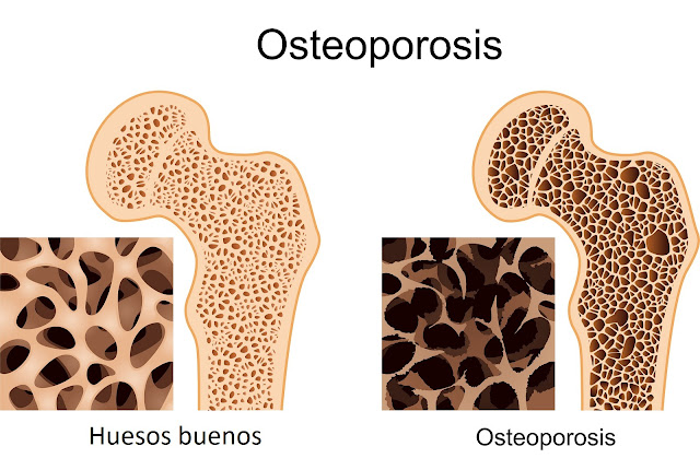 La Osteoporosis