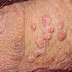 Penyebab Kutil Kelamin Hpv thumbnail
