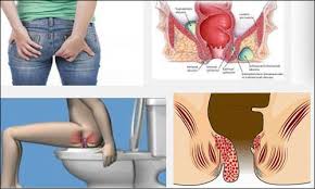 Obat Wasir Berdarah dan Tidak berdarah