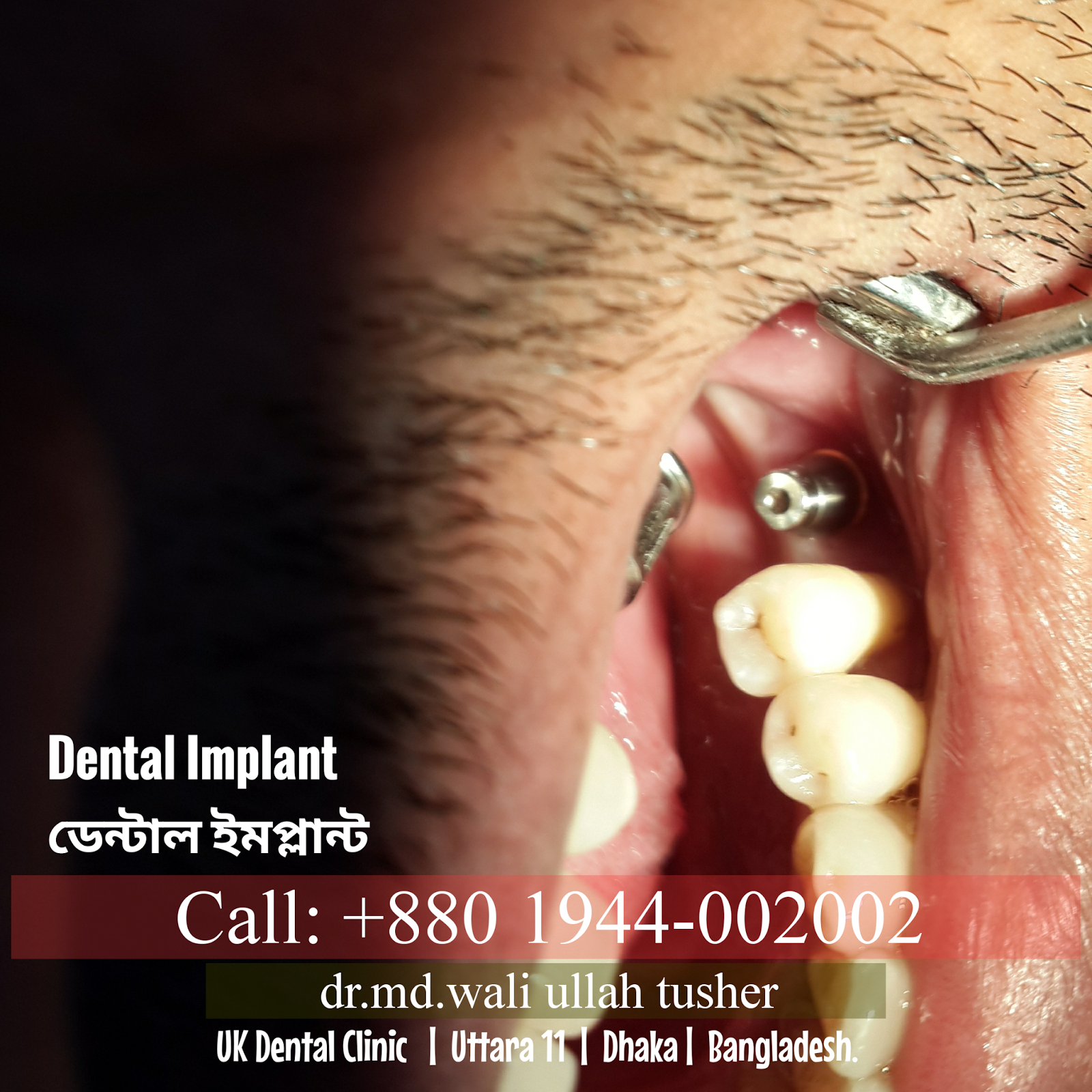 Dental Implant UK Dental Clinic Uttara Dhaka Bangladesh Dr.Md.Wali
