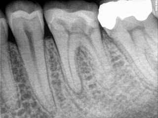 molar root canal