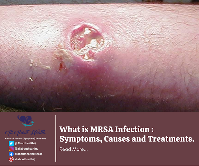 What is MRSA Infection Symptoms, Causes and Treatments. All About