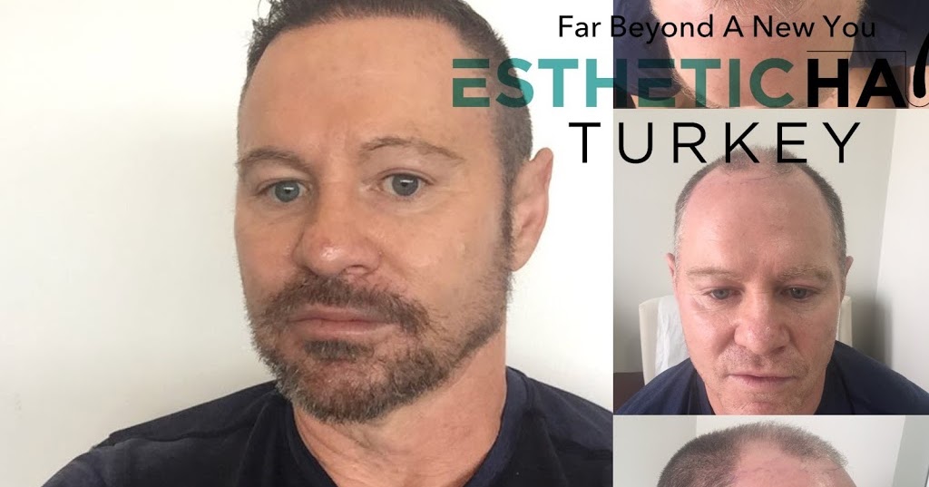 Medical Hair 4U Why Should You Get A Hair Transplant Treatment?