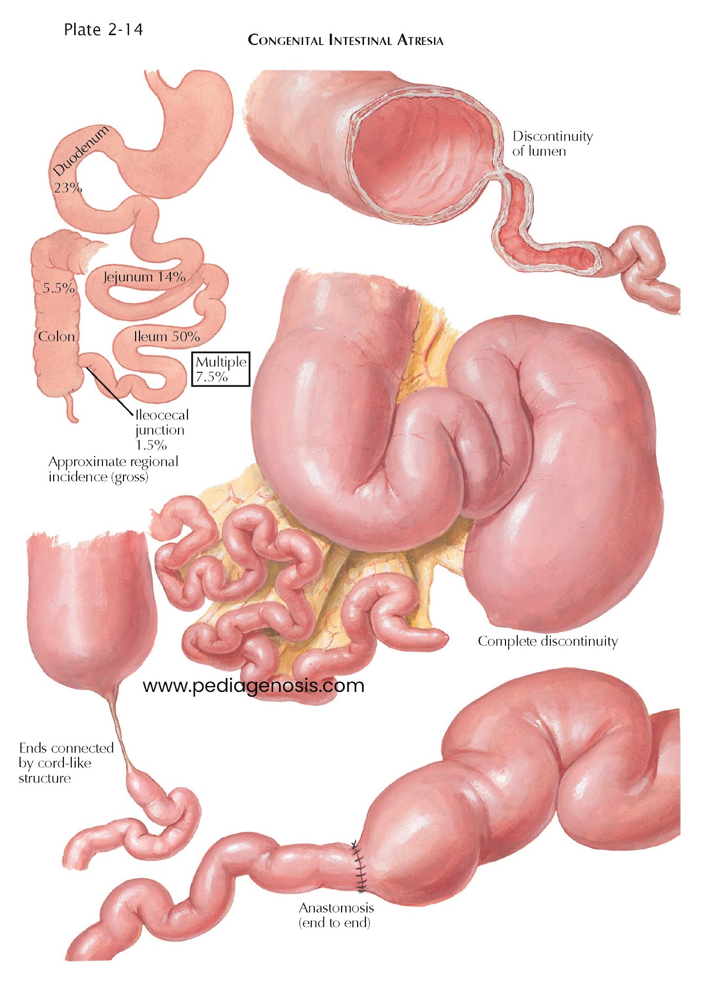 Congenital Intestinal Obstruction Intestinal Atresia, Malrotation of