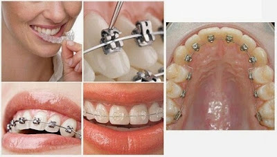 Giải đáp niềng răng có hại không từ nha sĩ-2