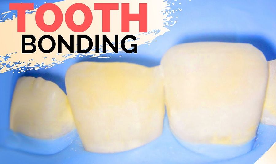 CLASS IV Composite Restoration Teeth Bonding Procedure Front Tooth