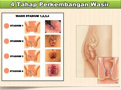 APOTIK YANG MENYEDIAKAN OBAT WASIR BERDARAH DI KOTA MAKASSAR