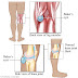 बेकर्स सिस्ट - Baker Cyst Disease Kya Hota Hain, Aur Iska Symptoms(Lakshan) Treatment (Upchar) Prevention(Roktham) Kaise Kare