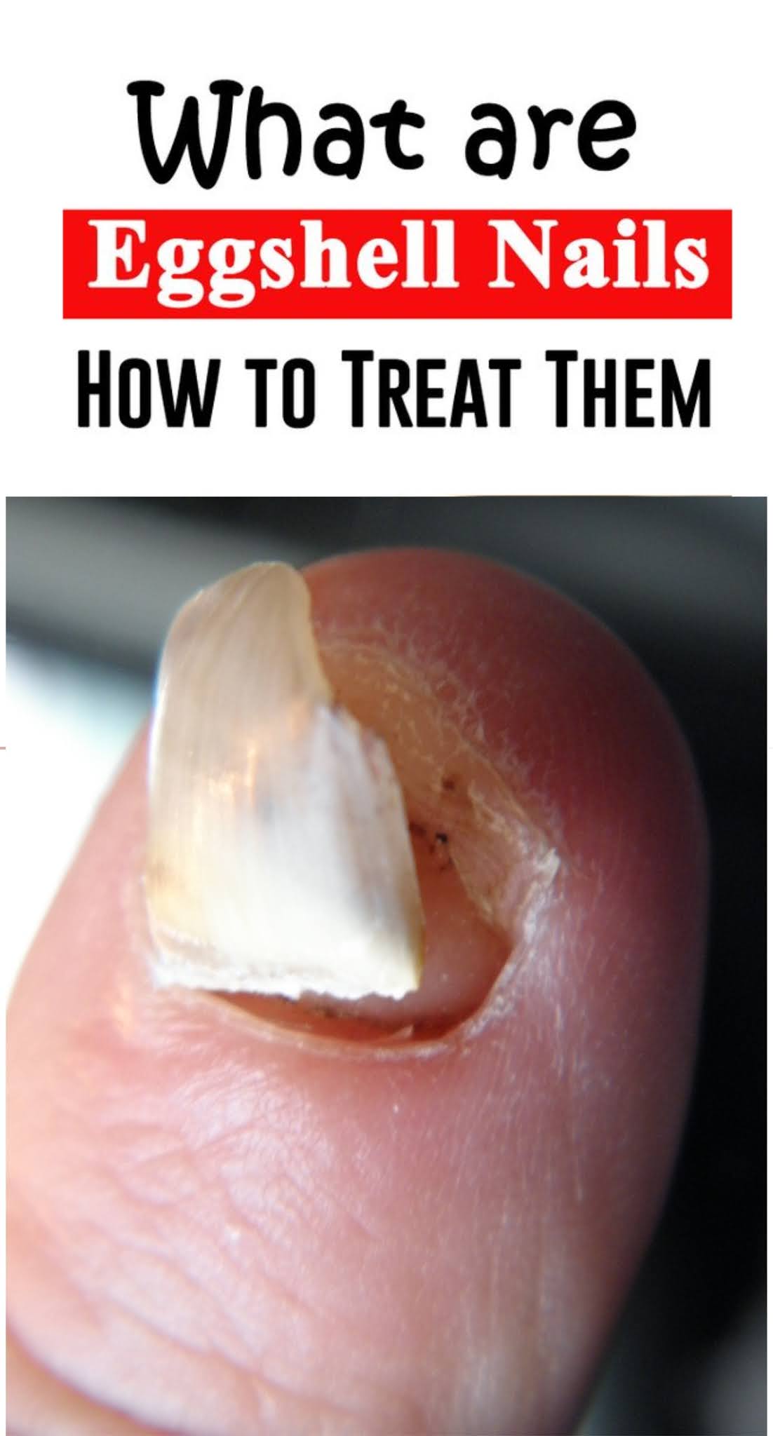 What are Eggshell Nails? How to Treat Them? Healthy Lifestyle