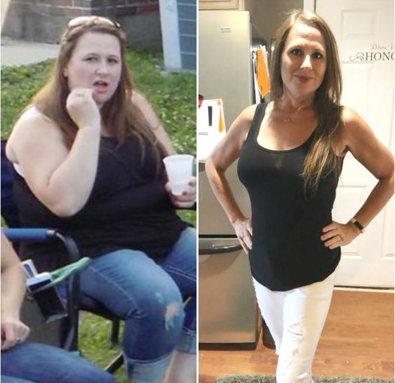 A Thigh Lift After Weight Loss What a Thigh Lift Procedure Entails