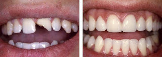Trám răng hàm bị vỡ có độ bền bao lâu?