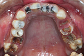 Cách xử lý sâu răng hàm trên hiệu quả 