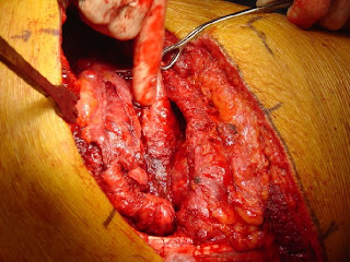 Healthy U: Lung Surgery