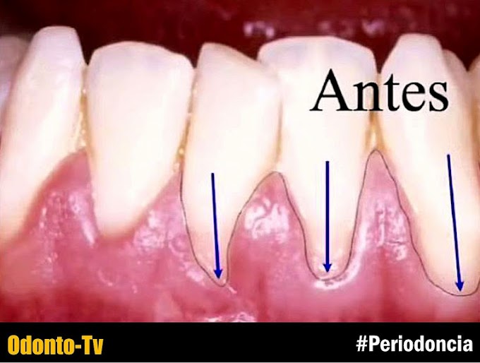 RECESIÓN GINGIVAL: Injerto conectivo para superarla - Dr. Baladrón