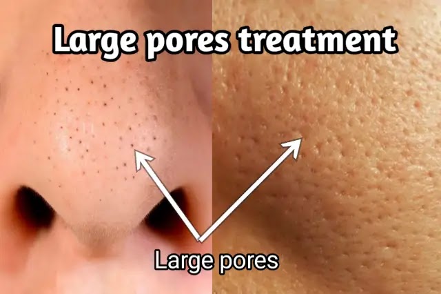 Large pores treatment: Medical and home methods large pores on face
