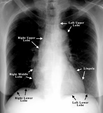 Far from the madding crowd.: How to read a Chest X-Ray (Basics)