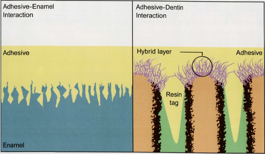 Step by step clinical adhesion 🏆 Dental Esthetics