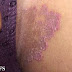 Obat Gatal Kurap/Loang Kering Di Selangkangan