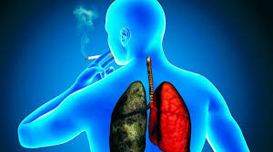 cáncer al pulmón