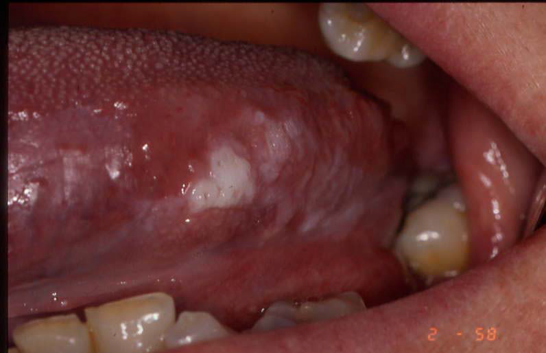 Diseases of the tongue