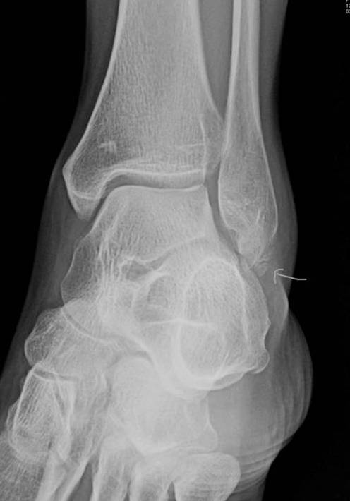 lateral malleolus fracture x ray lateral malleolus fracture x ray