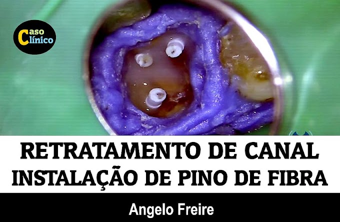 RETRATAMENTO ENDODONTIA: Dente 26 sem coroa instalação de pino de fibra - Angelo Freire