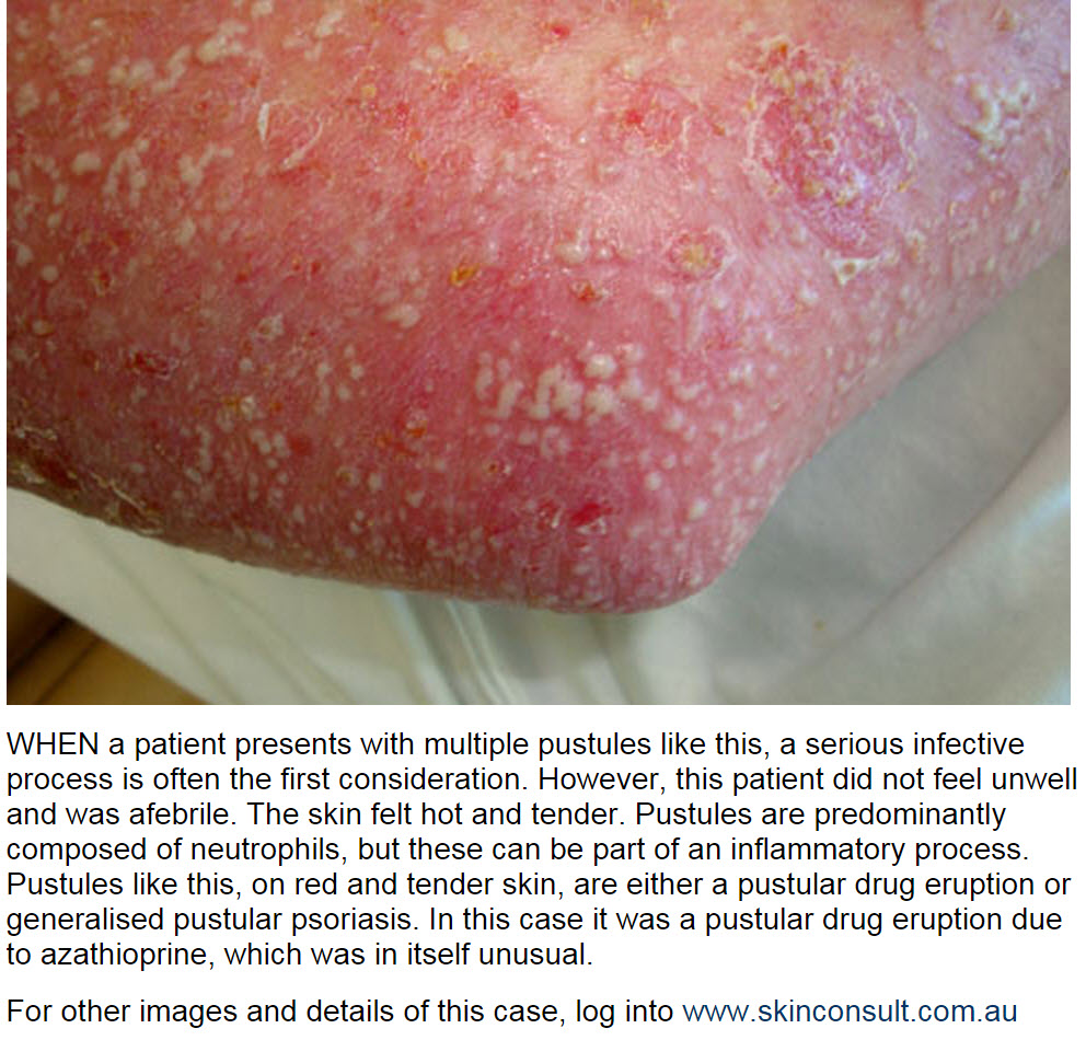 Consultations in Dermatology Pustular drug eruption