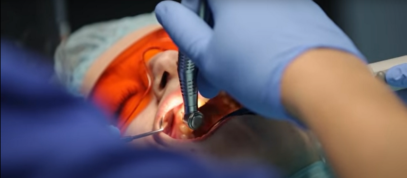 зубные импланты стоматология