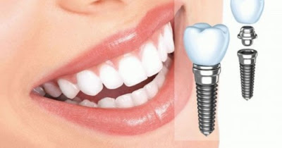 Trồng răng implant bao tiền?