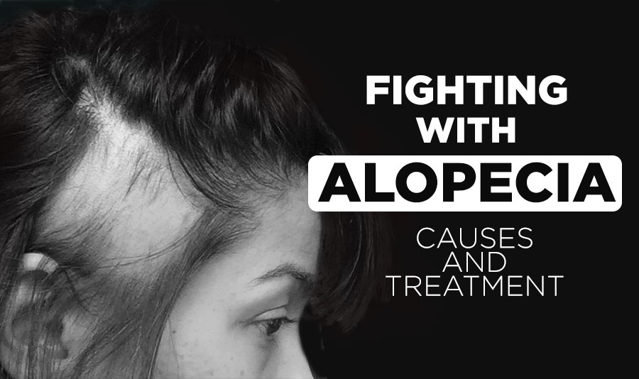 Fighting with Alopecia Areata: Causes and Treatment