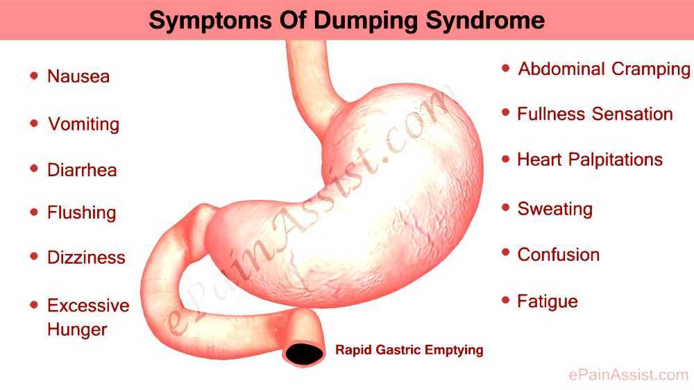 Dumping syndrome