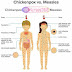 Chickenpox VS Measles