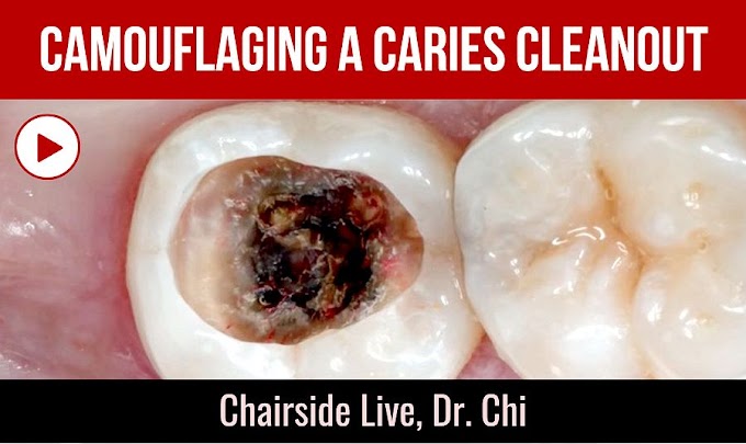 CLINICAL CASE: Camouflaging a Caries Cleanout - Dr. Chi