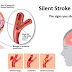 MUST WATCH: One Month Before Having Stroke, You Body Will Feel These Alert Signs!