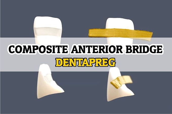 DENTAPREG: Composite Anterior Bridge - Dr. Eric Van Zytveld