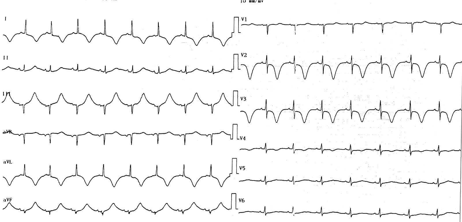 корытообразный сегмент st на экг. депрессия сегмента st на экг ii, iii,avf. экг горизонтальная депрессия сегмента st. отрицательное st. отрицательное st.