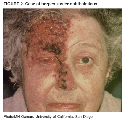 Herpes simplex | American Academy of Dermatology