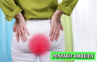 Foto Merk Obat Wasir Pada Ibu Menyusui Dan Hamil Yang Aman Di Apotik