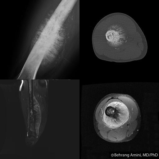 Roentgen Ray Reader Spiculated Periosteal Reaction Pathophysiology