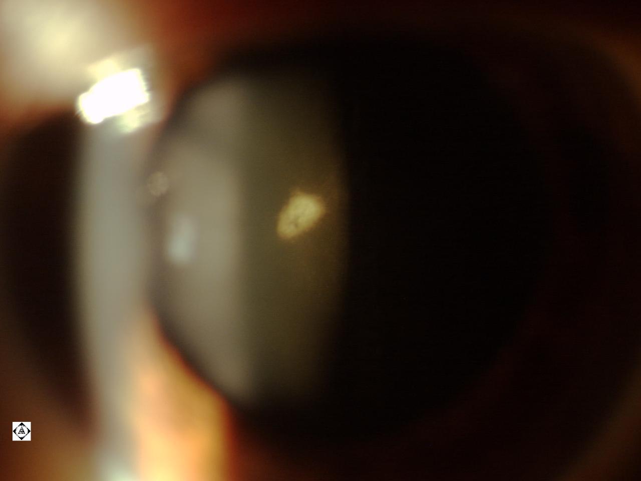 mittendorf-dot-sonoran-desert-eye-center