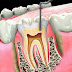 Điều trị tủy răng bằng phương pháp nào?