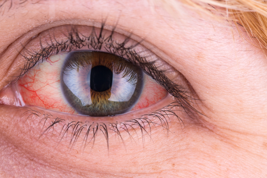 Why Your Eyes Might Be Red and Itchy HealthInfi HealthInfi We