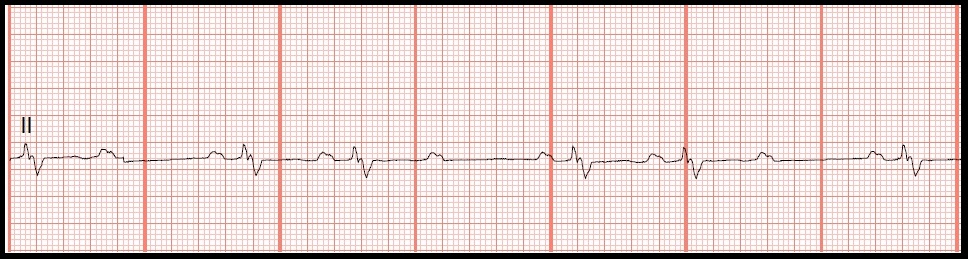 Practice EKG Rhythm Strips 138