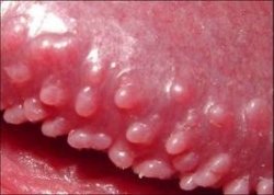 Pimples penile What Can