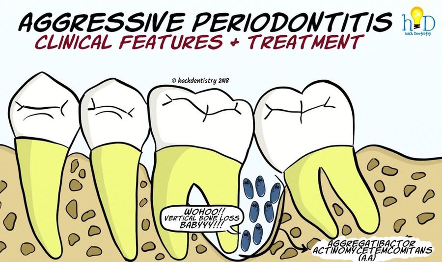 PERIODONTICS Aggressive Periodontitis Clinical features and Treatment