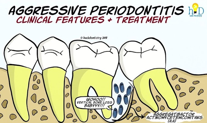 PERIODONTICS: Aggressive Periodontitis - Clinical features and Treatment